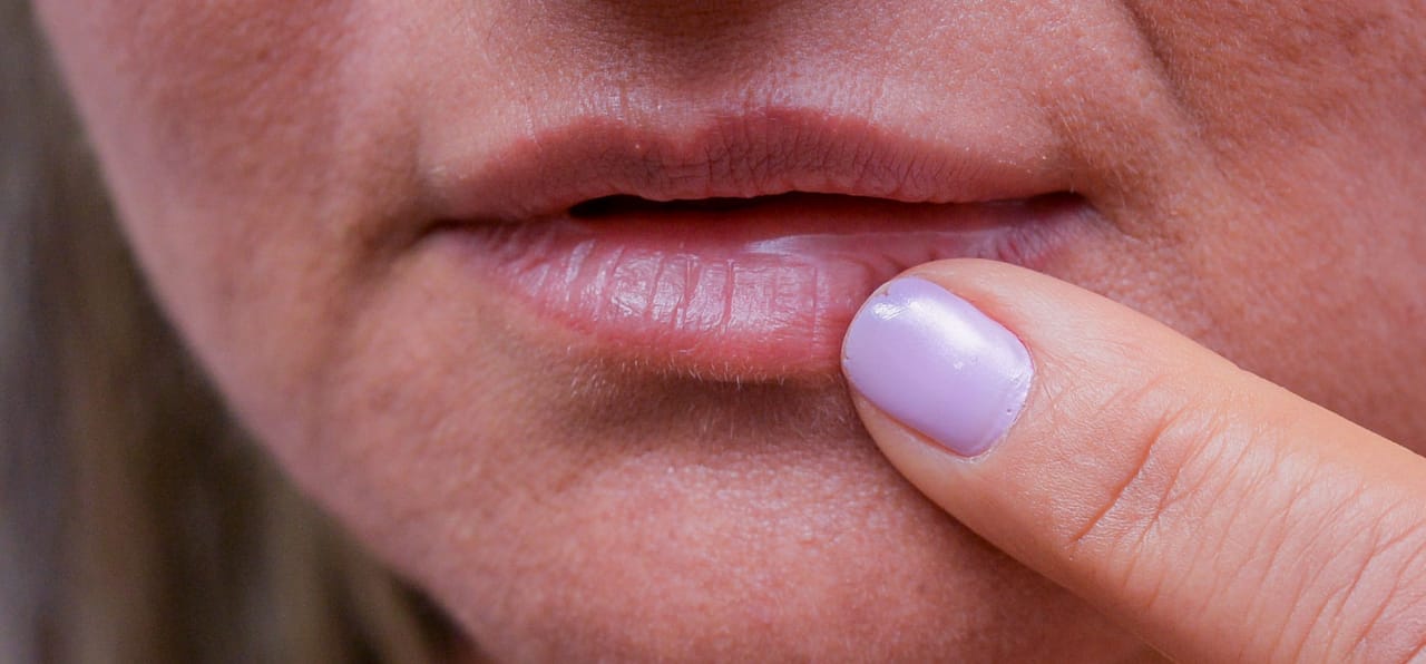 Saúde de Palmas orienta população sobre o herpes labial